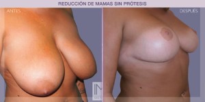 Before and after image of a breast reduction procedure.